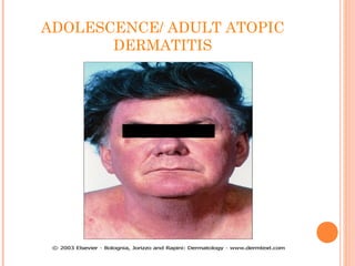 Atopic lick dermatitus - Adult archive